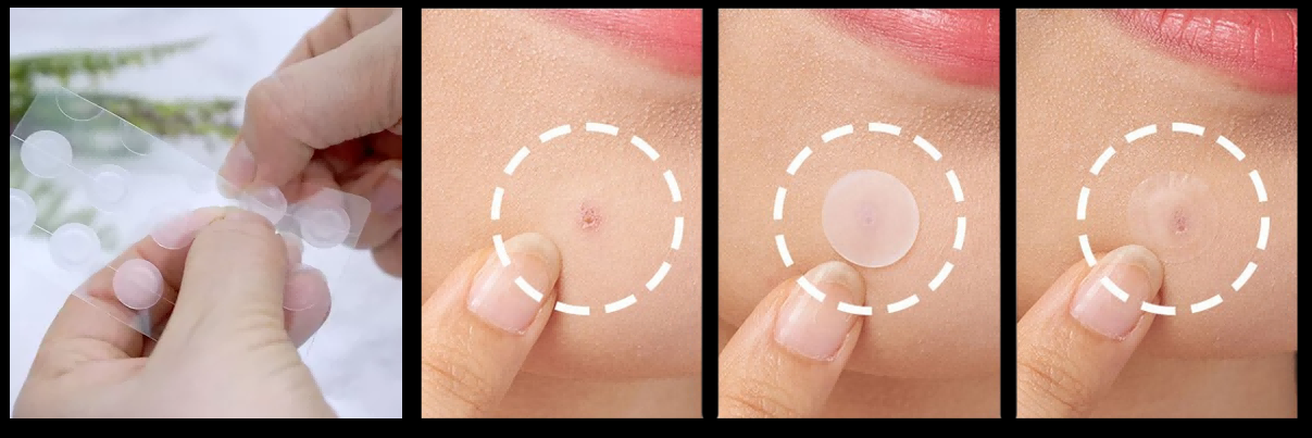 Acne pimple patch