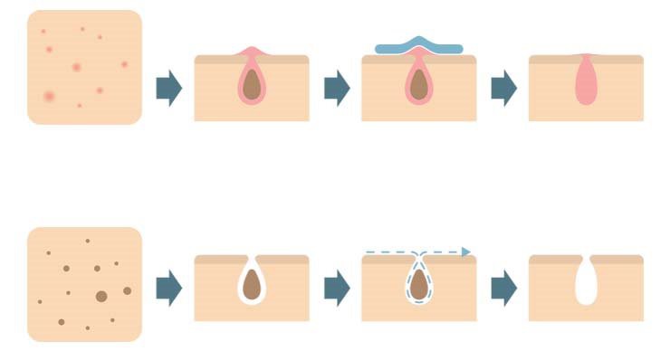 pimple patches pimple patches